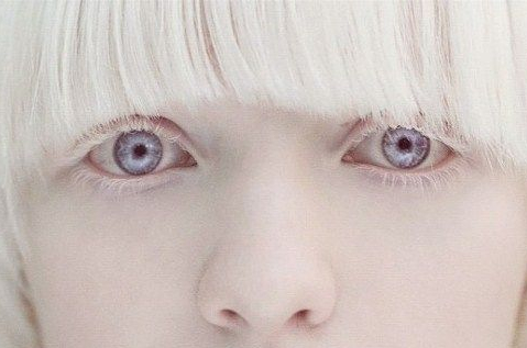 albina-eyes